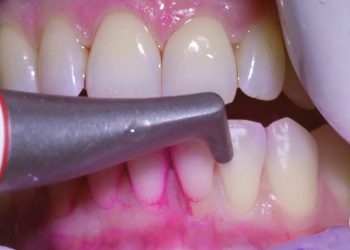 What will happen when doing professional teeth cleaning?