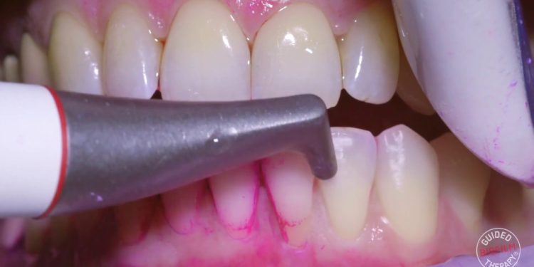 What will happen when doing professional teeth cleaning?