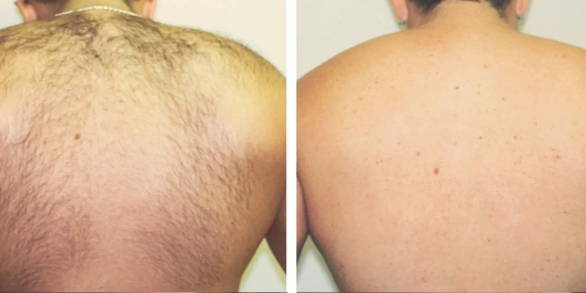 All about Laser Hair Removal in London, UK