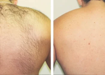 All about Laser Hair Removal in London, UK