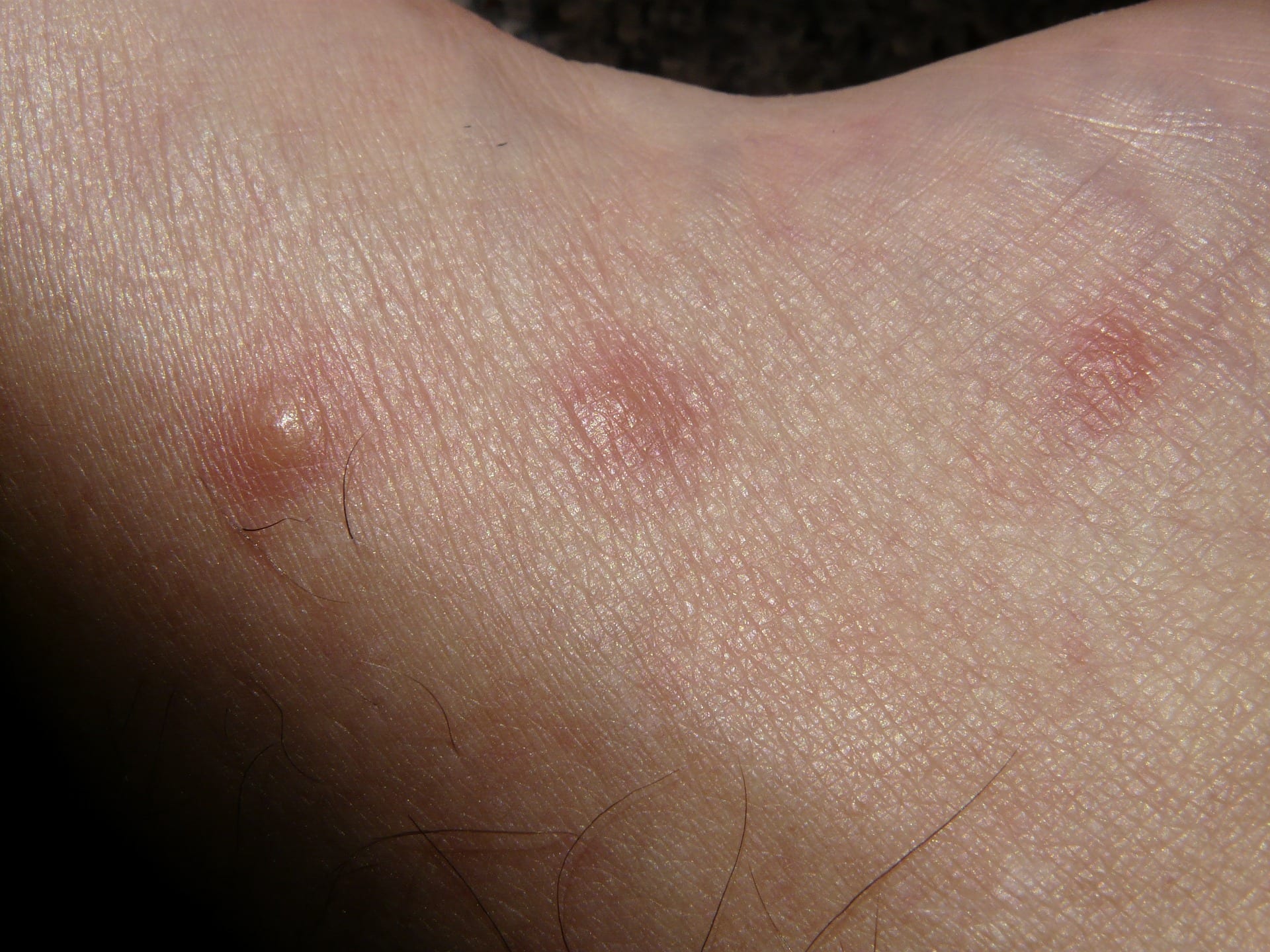 Common Types of Bug Bites and How to Identify Them